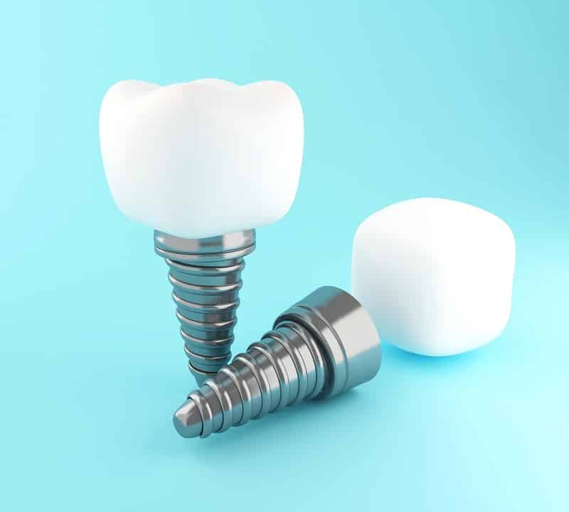 dental tooth implant