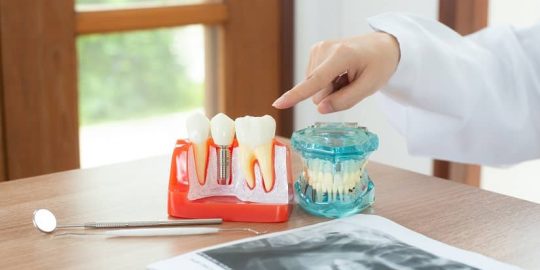 Get Dental Implants As The Permanent Solution