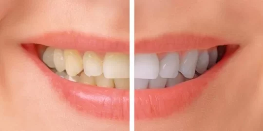 Best Teeth Whitening Treatment By Dentist
