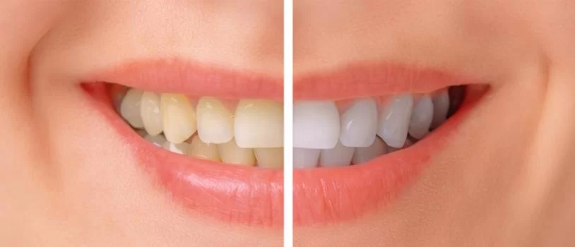 Teeth Whitening Treatment