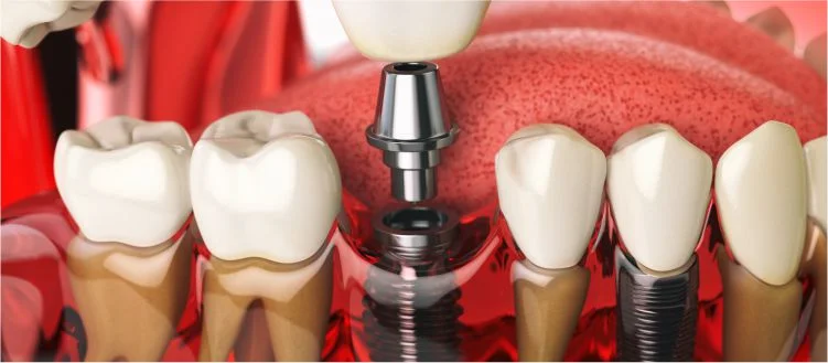 Dental Implants Frisco TX