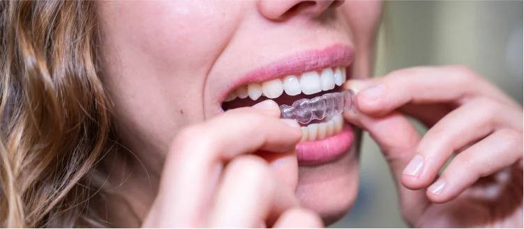 Invisalign Frisco TX