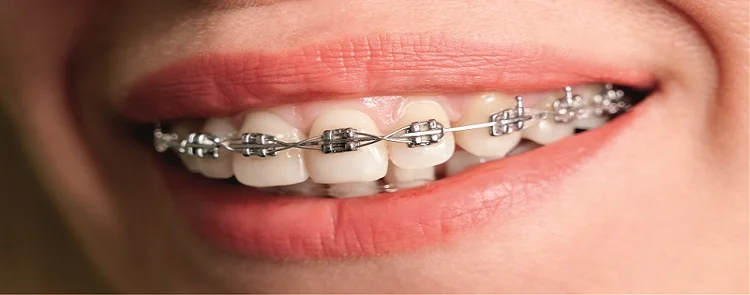 Dental Braces In Plano