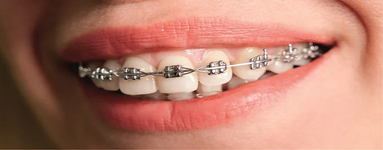 Braces: Which is Better: Metal Braces or Ceramic Braces