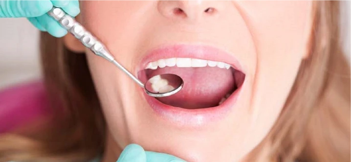 Oral Cancer Awareness - Poor Oral Hygiene Link