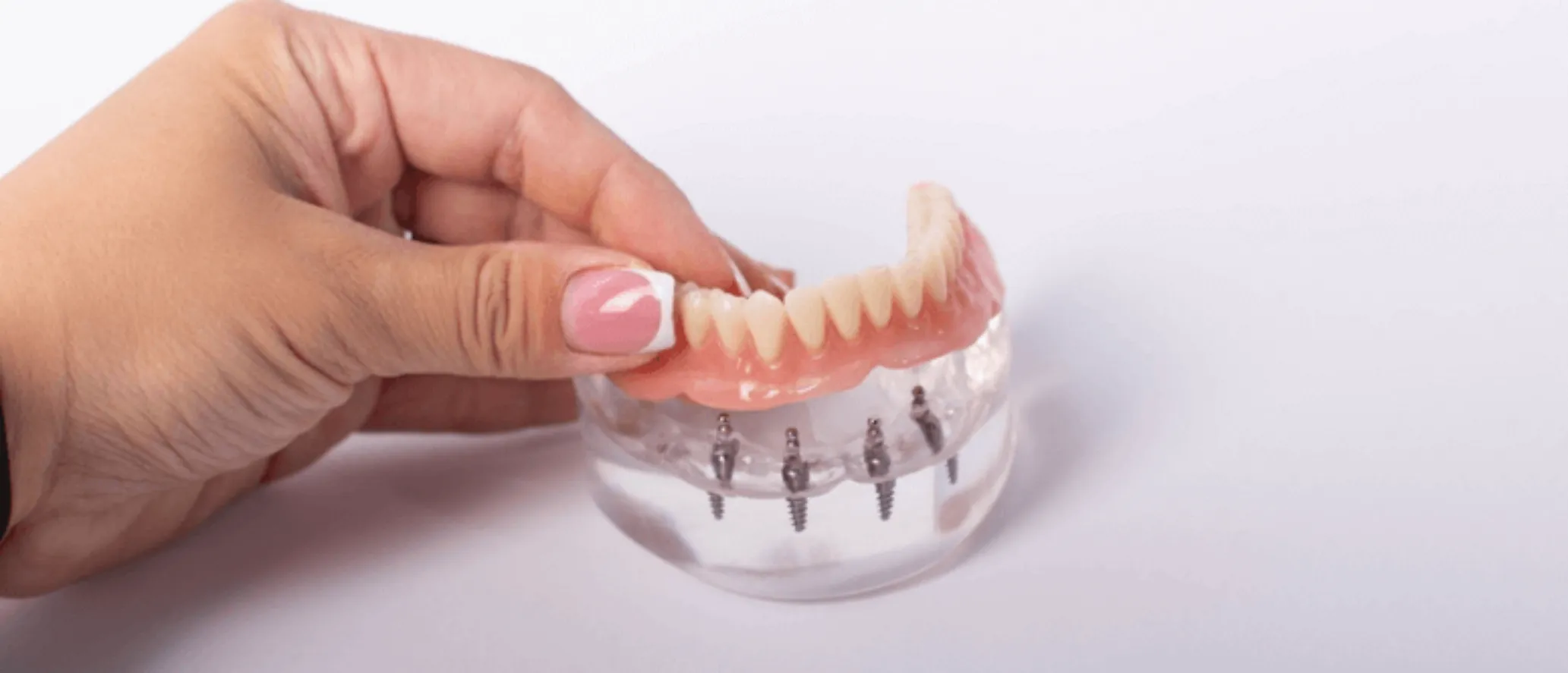All-On-4 Dental Implants Maintenance Tips
