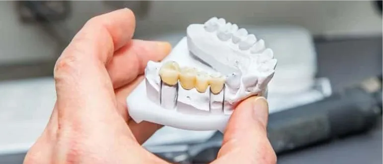 Dental Bridge: Settling Time Explained