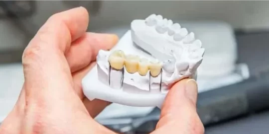 How Long Does It Take For A Dental Bridge To Settle?