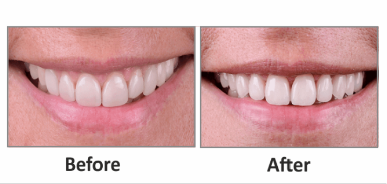 Teeth Sensitivity 