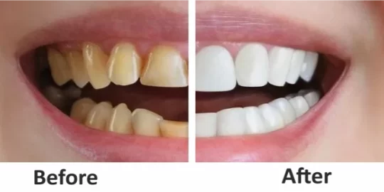 Front Teeth Crowns Before And After – Stunning Transformations