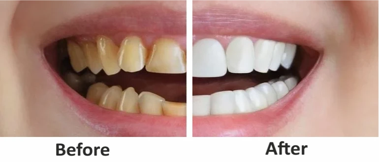 Front Teeth Crowns