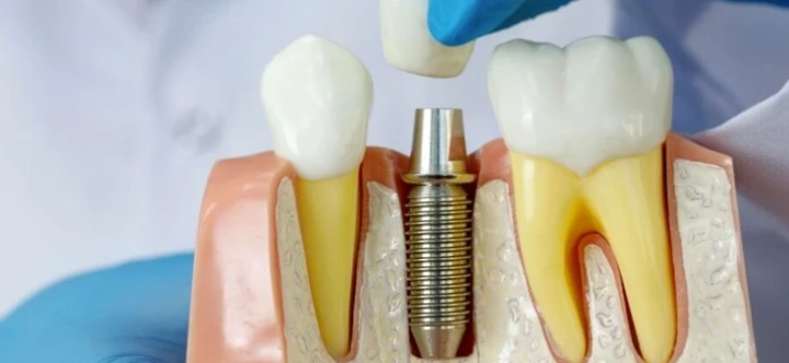 3 Types of Dental Implants