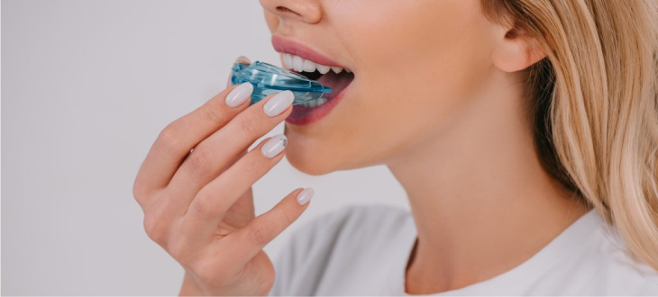 Custom Mouthguard