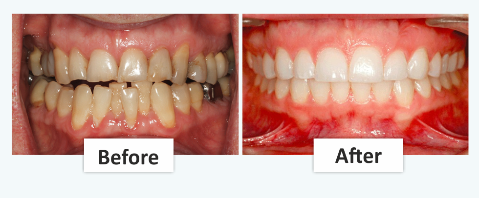 Tooth extraction Performance