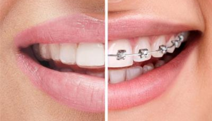 teen-invisalign-vs-metal-braces-plano