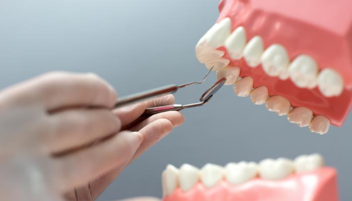 How Dental Bridges Are Designed to Match Your Natural Smile
